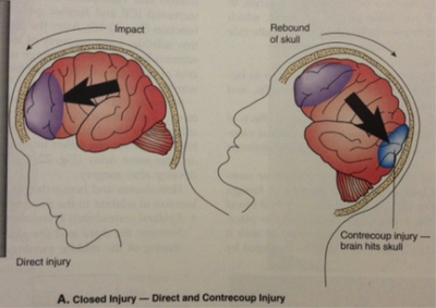 injury brain mechanism traumatic weebly
